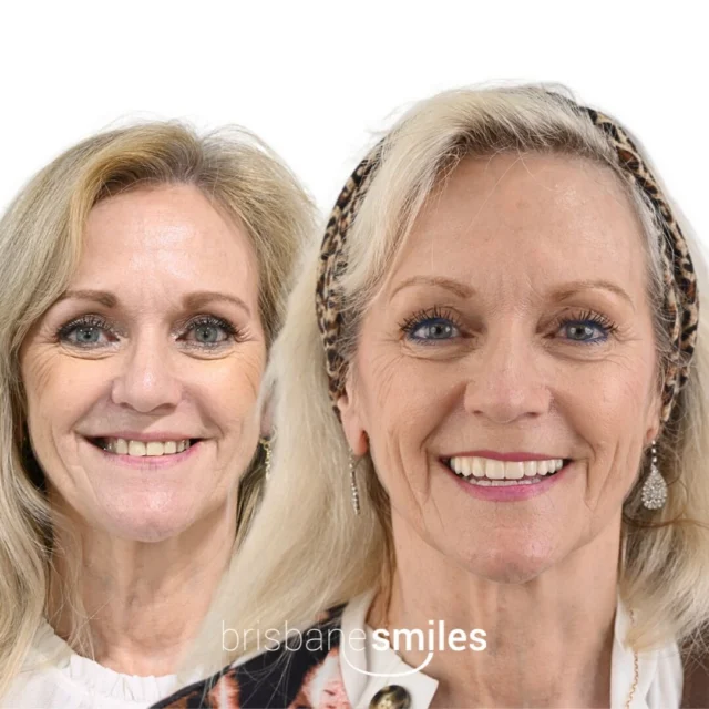 This beautiful lady came to Brisbane Smiles looking for a solution for her broken and missing teeth. A complete SmiLUXA Full Jaw Implant smile restoration was created, by using upper and lower full-arch dental implants, sinus grafts and custom-designed fixed zirconia bridges for exceptional aesthetics, strength, and long-term function. 

If you would like to learn more about Full Jaw Implants or how to improve your missing teeth with Dental Implants, then our SmiLUXA Full Jaw Complimentary Consultation service can help you explore your options. 

Book online via bsmiles.au or call our friendly team on 3870 3333. 

#brisbanesmiles #beforeandafter #smiluxa #fulljawimplants

⚠️ Treatment outcomes differ for each individual and cannot be guaranteed. These photos feature actual patients and are for informational purposes only. All surgical or invasive procedures carry risks. Before proceeding, consult a qualified health practitioner and seek a second opinion. Go to bsmiles.au/txinfo to learn about potential risks and important treatment considerations.