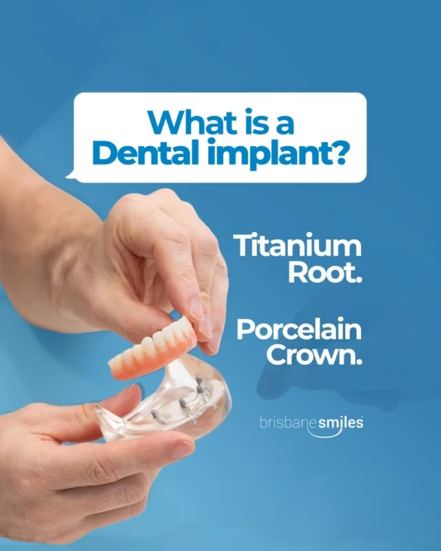 "What actually IS a dental implant?"

A dental implant is a titanium post placed into the jawbone, acting as the root for a new tooth. Once it's healed and bonded with the bone, a custom porcelain crown is attached on top.

The result: a replacement tooth that looks, feels and functions like the real thing.

Curious if you're a candidate? Book a complimentary consult at www.bsmiles.au or call 3870 3333.
#brisbanesmiles #dentalimplants #toothreplacement

⚠️ Treatment outcomes differ for each individual and cannot be guaranteed. All photos and videos are for informational purposes only. All surgical or invasive procedures carry risks. Before proceeding, consult a qualified health practitioner and seek a second opinion. Go to bsmiles.au/txinfo to learn about potential risks and important treatment considerations.