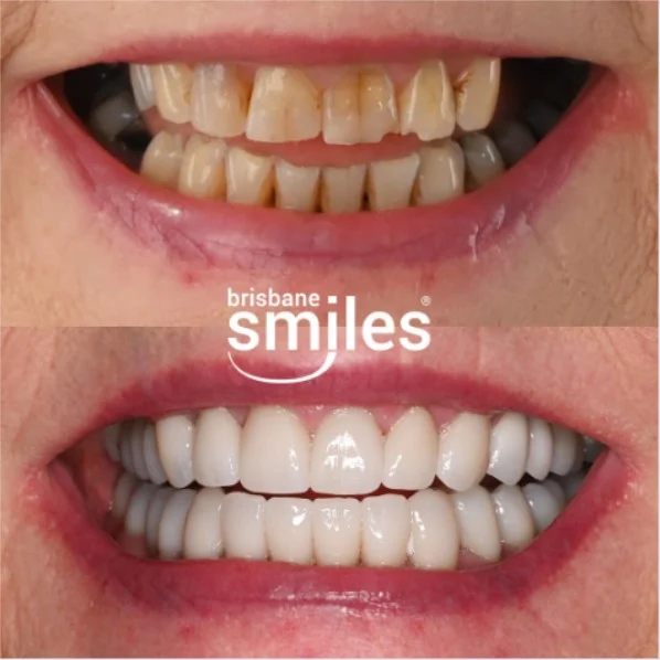 A smile transformation with porcelain crowns ✨🦷 For this patient, upper and lower porcelain crowns were used to strengthen teeth that were cracking and chipping, while also improving their shape and colour. Each crown was carefully planned and custom-crafted in our in-house Dental Laboratory as part of their Smile Makeover.

Porcelain crowns can restore and protect damaged teeth, combining strength with a natural-looking finish.

Smile Makeovers are individually designed, taking into account your teeth, facial features and what you would like to achieve.

Provider: Andrei Mihailescu
General Dentist (DEN0002177882)

Book a free Smile Makeover consultation today to explore what may be possible for your smile. 
📅 Book online at brisbanesmiles.com.au or phone 3870 3333. 

#BrisbaneSmiles #SmileMakeover #PorcelainCrowns

⚠️ Treatment outcomes differ for each individual and cannot be guaranteed. All photos and videos feature actual patients and are for informational purposes only. All surgical or invasive procedures carry risks. Before proceeding, consult a qualified health practitioner and seek a second opinion. Go to bsmiles.au/txinfo to learn about potential risks and important treatment considerations.