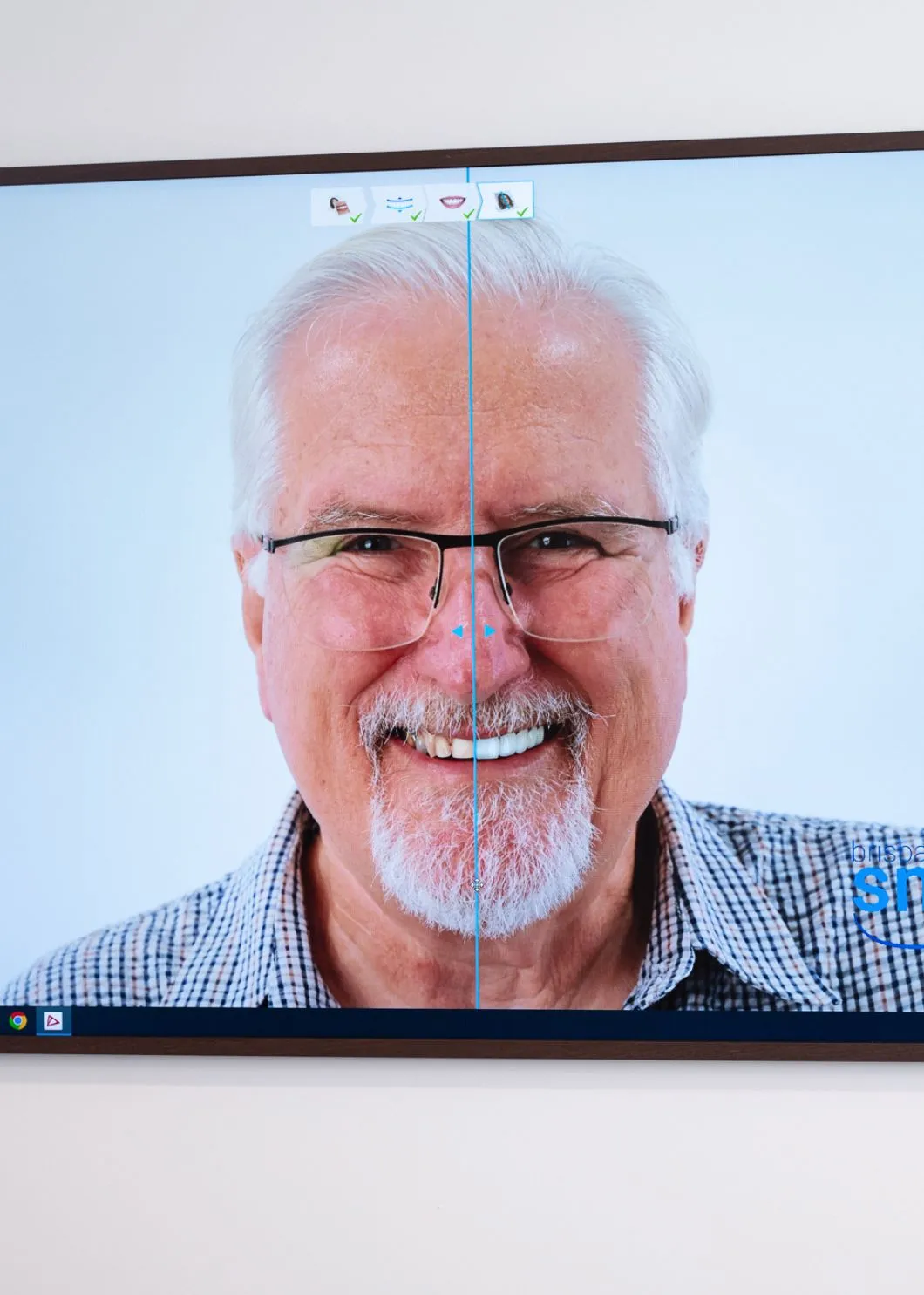 Dental implants at brisbane smiles toowong