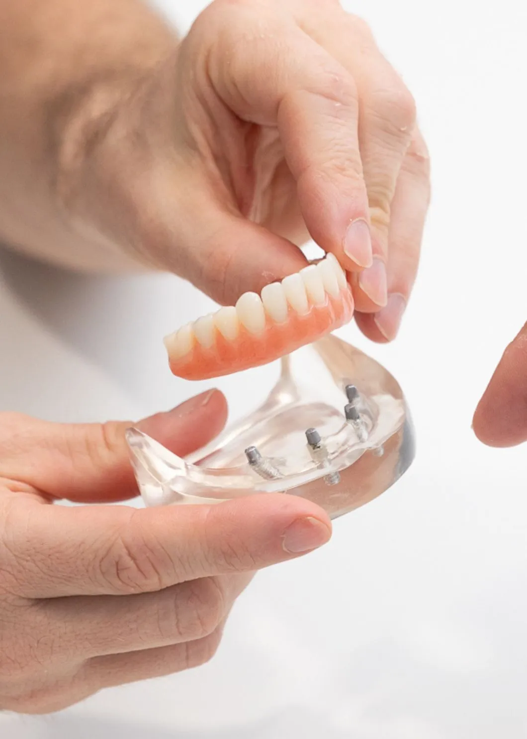Dental implants at brisbane smiles toowong consult