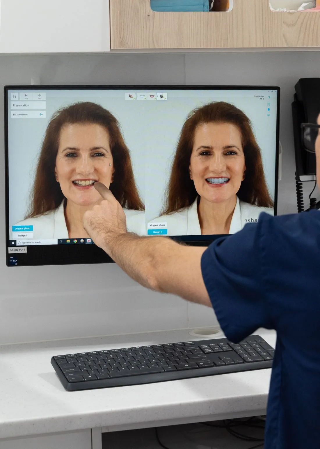 The Smile Makeover 4-Step Treatment Process Brisbane Smiles